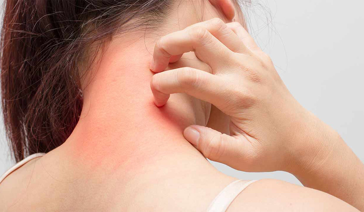¿Qué es la Alergia Al Polvo? | Síntomas, Causas Y Cómo Tratar La Enfermedad
